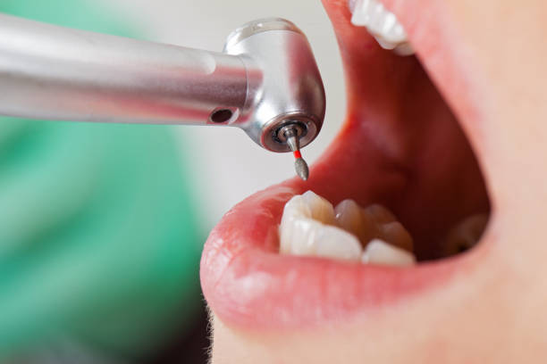 Best Emergency Wisdom Teeth Removal in Ravenel, SC